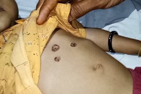 अंधविश्वास : इलाज के नाम पर परिजनों ने 13 दिन की बच्ची को गर्म सलाखों से दर्जनों जगह दागा, हालत गंभीर