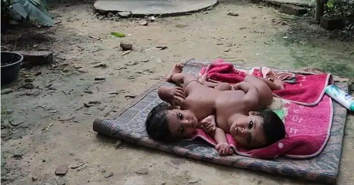 केजीएमयू में पहली बार लीवर से जुड़े दो जुड़वा बच्चों को किया गया अलग