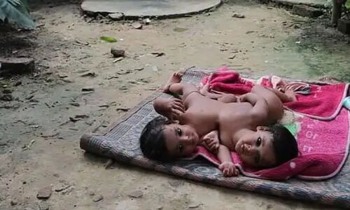 केजीएमयू में पहली बार लीवर से जुड़े दो जुड़वा बच्चों को किया गया अलग