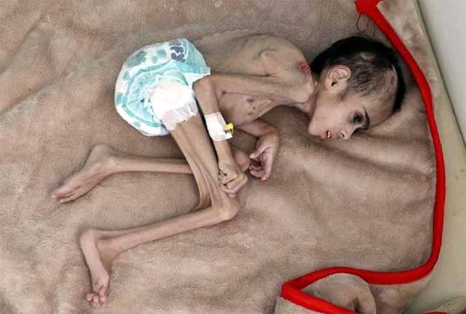 सामने आई भयावह तस्वीर, भूख की वजह से कंकाल में बदल गया बच्चा, सिर्फ 7 किलो है वजन