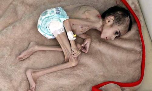 सामने आई भयावह तस्वीर, भूख की वजह से कंकाल में बदल गया बच्चा, सिर्फ 7 किलो है वजन