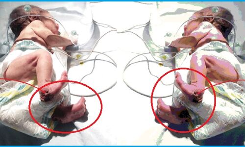 बरेली में खेत में फेंकी 1 दिन की नवजात बच्ची का पैर कुतरा कीड़ों ने, रोने की आवाज सुन नौलखराम के परिवार ने बचायी जान