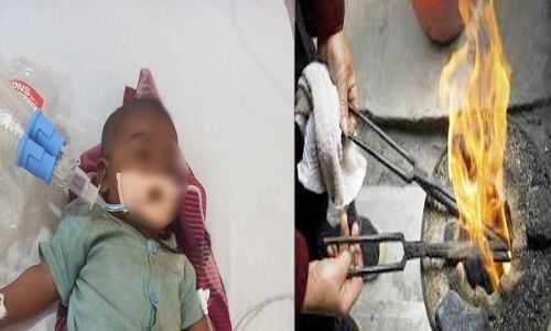 अंधविश्वास की बलि चढ़ गयी 5 माह की मासूम, पेट दर्द की तकलीफ पर मां ने गर्म सरिये से था दागा अंधविश्वास की बलि चढ़ गयी 5 माह की मासूम, पेट दर्द की तकलीफ पर मां ने गर्म सरिये से था दागा