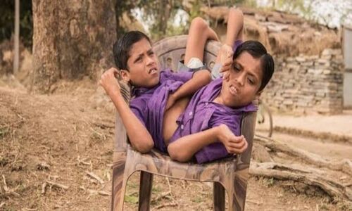 Twin Brothers Death: शरीर से जुड़े दो भाइयों की मौत बनी पहेली, आखिरी वीडियो में पिता पर लगाया प्रताड़ना का आरोप