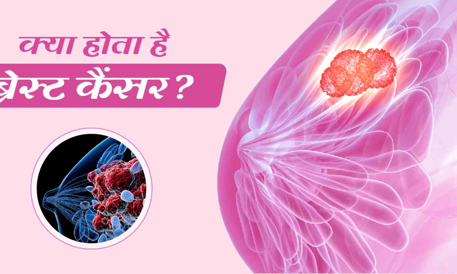 Breast Cancer Kya Hai? ब्रेस्ट कैंसर क्या है? ब्रेस्ट कैंसर के प्रकार,  ब्रेस्ट कैंसर के लक्षण क्या हैं? ब्रेस्ट कैंसर की कितनी स्टेज होती हैं?  ब्रेस्ट