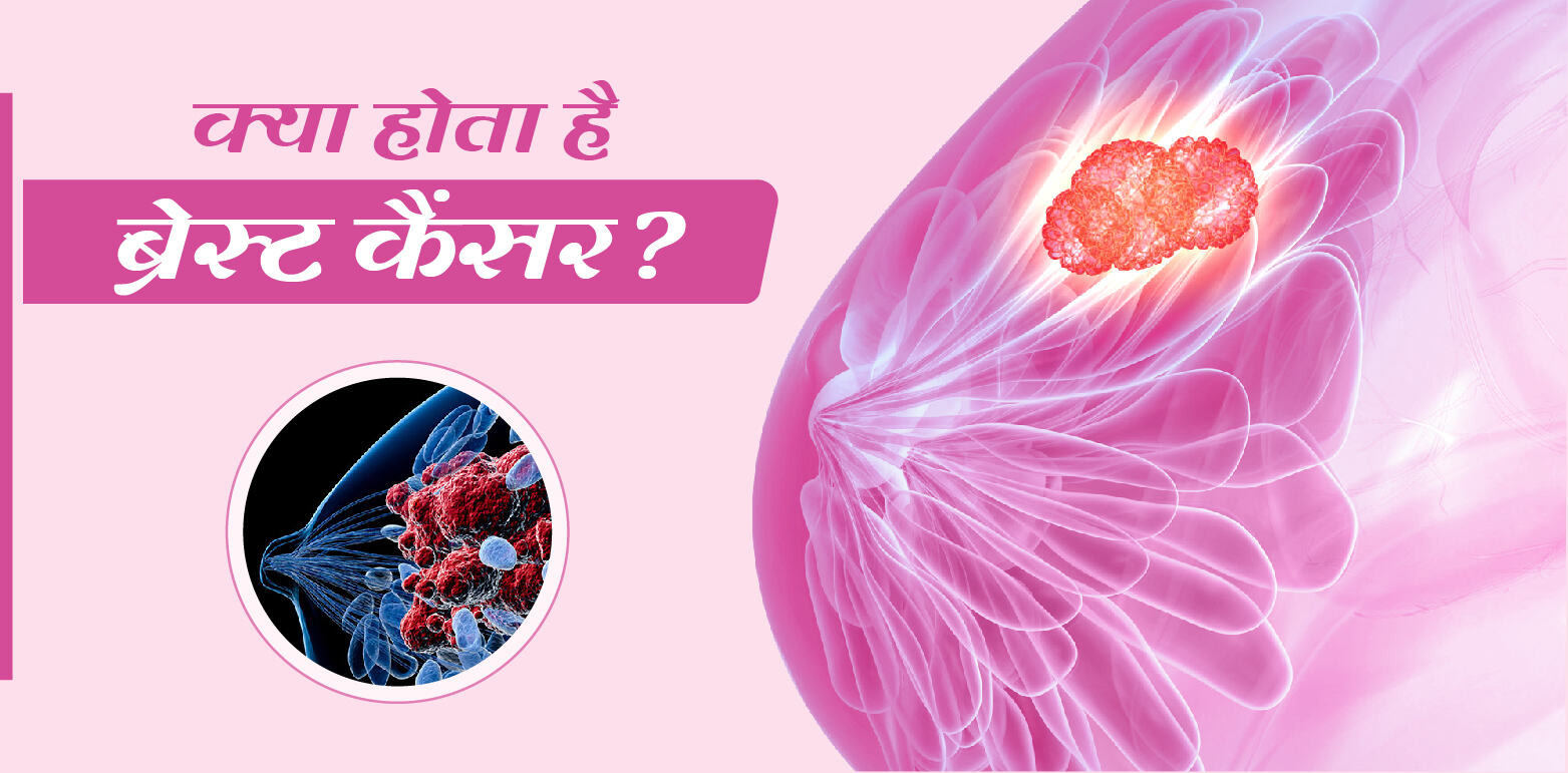 Breast Cancer Kya Hai? ब्रेस्ट कैंसर क्या है? ब्रेस्ट कैंसर के प्रकार, ब्रेस्ट कैंसर के लक्षण क्या हैं? ब्रेस्ट कैंसर की कितनी स्टेज होती हैं? ब्रेस्ट कैंसर की जांच कैसे होती है? ब्रेस्ट कैंसर से बचाव क्या है?