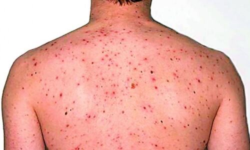 Monkeypox Alert in UP : यूपी में बढ़ा मंकीपॉक्स का खतरा, अचानक CMO ने जारी की एडवाइजरी तो मचा हड़कप, बरतें ये सावधानी वरना Monkeypox Alert in UP : यूपी में बढ़ा मंकीपॉक्स का खतरा, अचानक CMO ने जारी की एडवाइजरी तो मचा हड़कप, बरतें ये सावधानी वरना