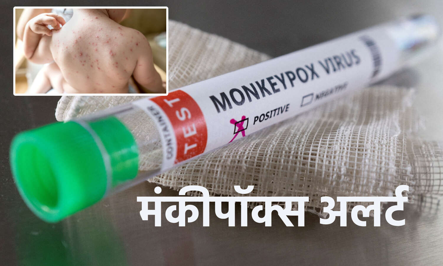 Monkeypox Virus : दिल्ली में मंकीपॉक्स का मिला पांचवां मरीज, LNJP अस्पताल में भर्ती महिला संक्रमित