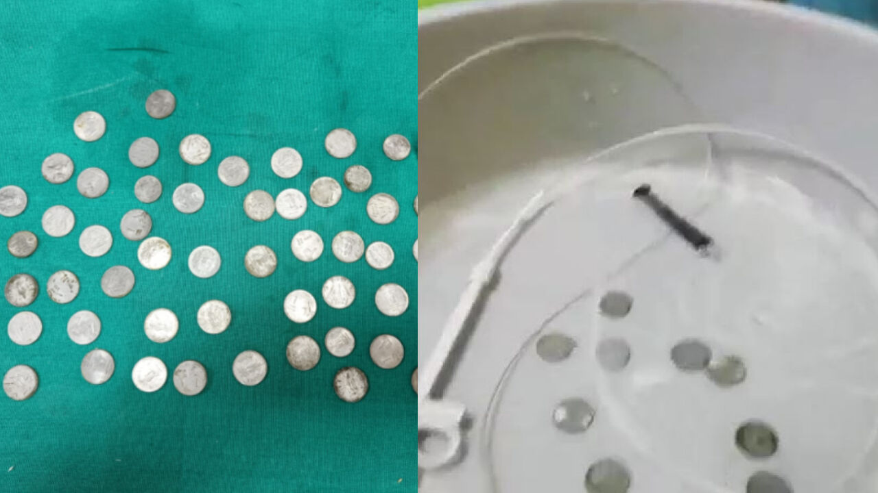 युवक के पेट से निकले 63 सिक्के, एक्स-रे देख डॉक्टर्स भी हैरान, डेढ़ घंटे तक चला ऑपरेशन...