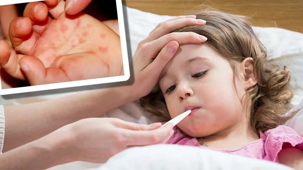 Tomato Flu Kya Hai: टोमेटो फ्लू क्या है? बच्चों में बुखार के साथ ये लक्षण दिखे तो हो सकता है टोमेटो फ्लू?