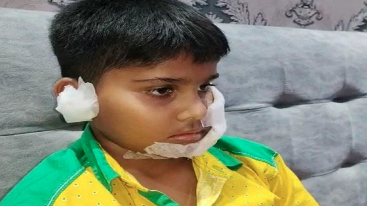 Ghaziabad News : पिटबुल ने बच्चे के चेहरे पर बेरहमी से काटा, सर्जरी में लगे 150 टांके