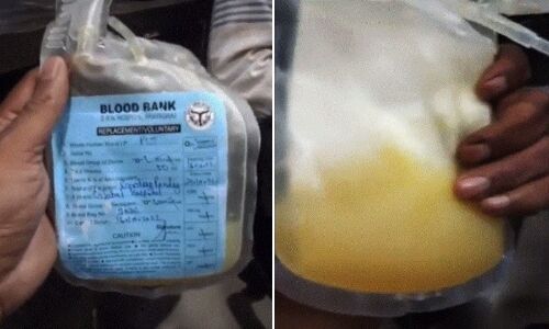 यूपी के इलाहाबाद में डेंगू मरीज को प्लेटलेट्स की जगह चढ़ा दिया मौसमी का जूस, मरीज की हुई मौत