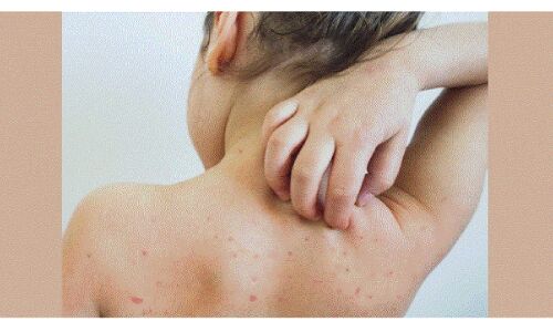 WHO ने माना, 4 करोड़ बच्चों पर मंडराया खसरे का खतरा, कोविड-19 की वजह से नहीं लग पाये थे टीके