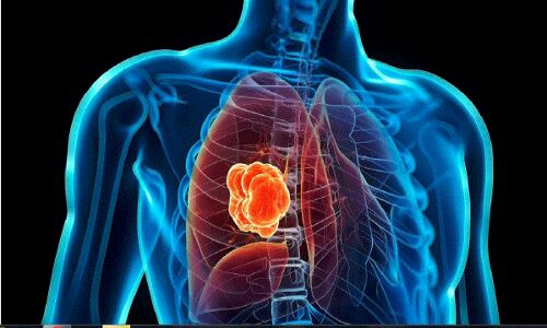 चिंता की बात : भारत में बढ़ रहे फेफड़ों के कैंसर के मामले, 50% रोगी धूम्रपान न करने वाले