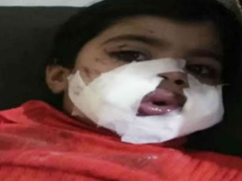 3 साल की बच्ची के मुंह में पड़ोसी युवक ने फोड़ा बम, हालत नाजुक