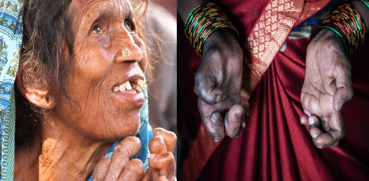 कोरोना का कुष्ठ रोगियों पर पड़ेगा व्यापक असर, भारत में हैं दुनिया के 50% से ज्यादा कुष्ठ रोगी