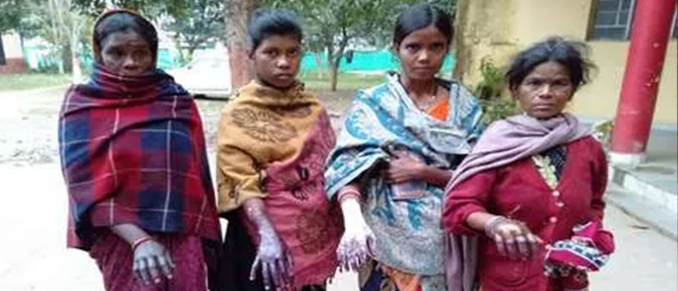 अंधविश्वास : झारखंड में पंचायत ने चार महिलाओं को डायन बताकर खौलते पानी से सिक्का निकालने की दी सजा