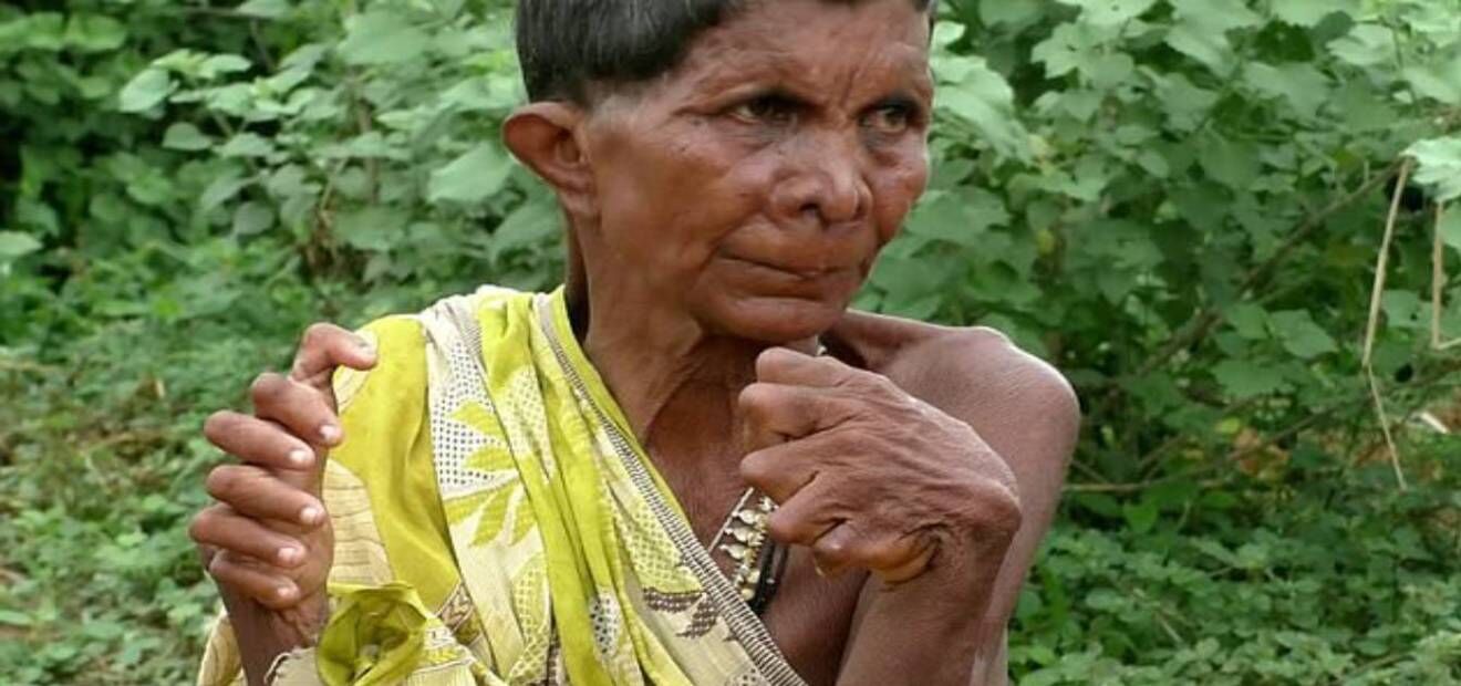 ओडिशा की 31 उंगलियाें वाली 63 वर्षीय बुजुर्ग महिला को छोड़ना पड़ा अपना घर, क्योंकि पड़ोसी करते थे डायन कहकर प्रताड़ित
