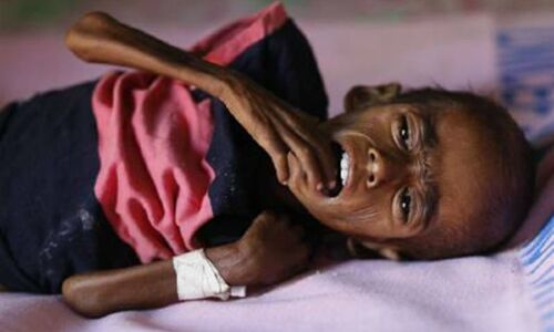 मध्य प्रदेश में दिहाड़ी मजदूर के 8 साल के बेटे की भूख से मौत, पूरा परिवार अस्पताल में भर्ती