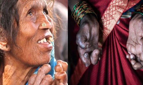 कोरोना का कुष्ठ रोगियों पर पड़ेगा व्यापक असर, भारत में हैं दुनिया के 50% से ज्यादा कुष्ठ रोगी